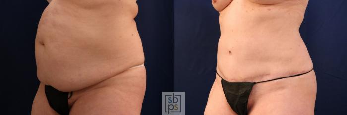 Before & After Tummy Tuck Case 753 Left Oblique View in Los Angeles, Torrance & Long Beach, CA