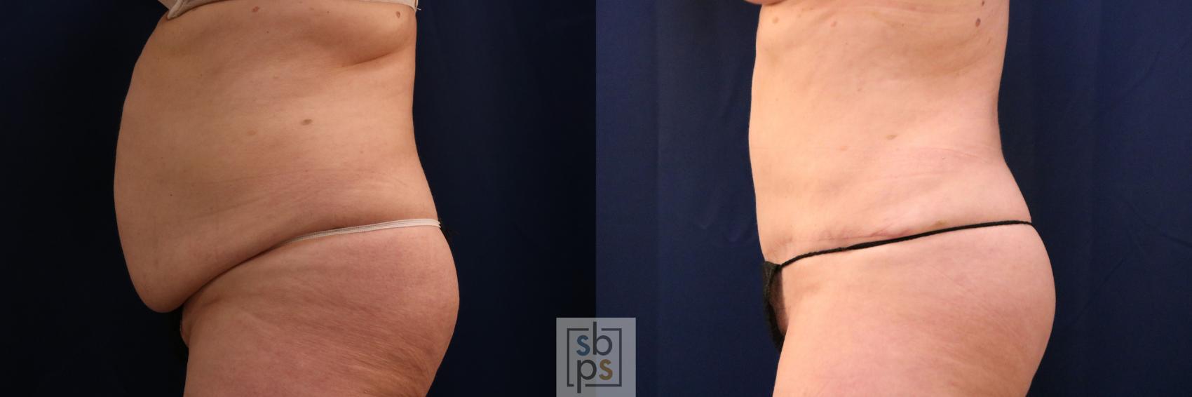 Before & After Tummy Tuck Case 753 Left Side View in Los Angeles, Torrance & Long Beach, CA