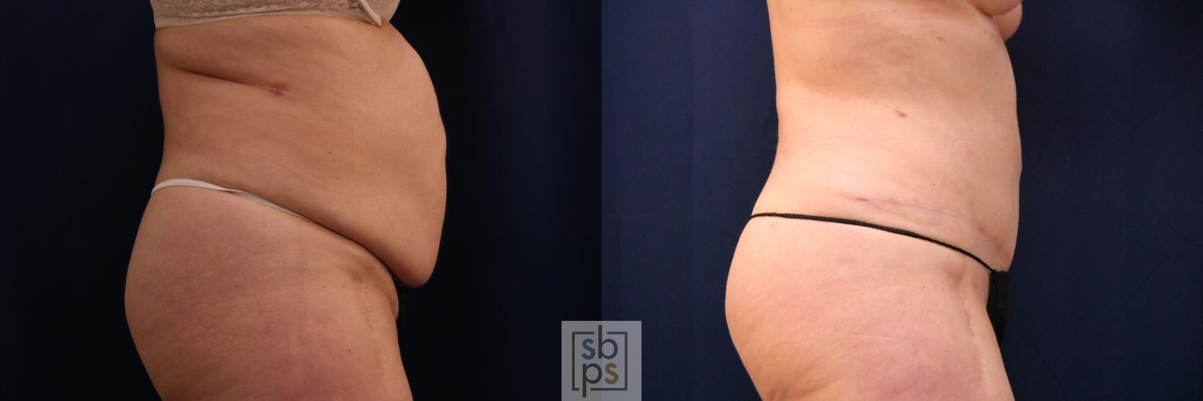 Before & After Tummy Tuck Case 753 Right Side View in Los Angeles, Torrance & Long Beach, CA