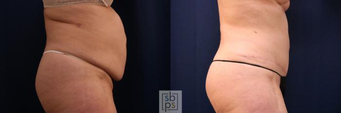 Before & After Tummy Tuck Case 753 Right Side View in Los Angeles, Torrance & Long Beach, CA