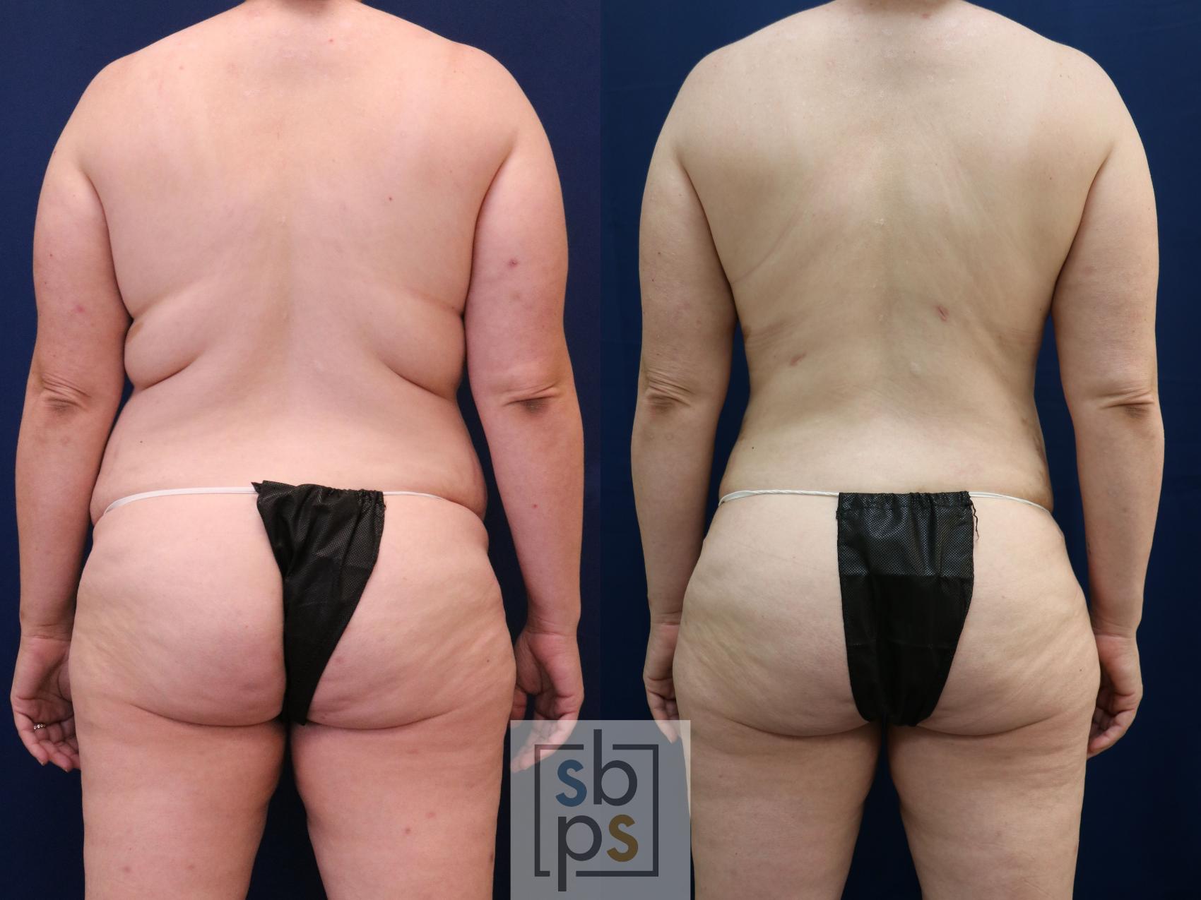 Before & After Tummy Tuck Case 754 Back View in Los Angeles, Torrance & Long Beach, CA