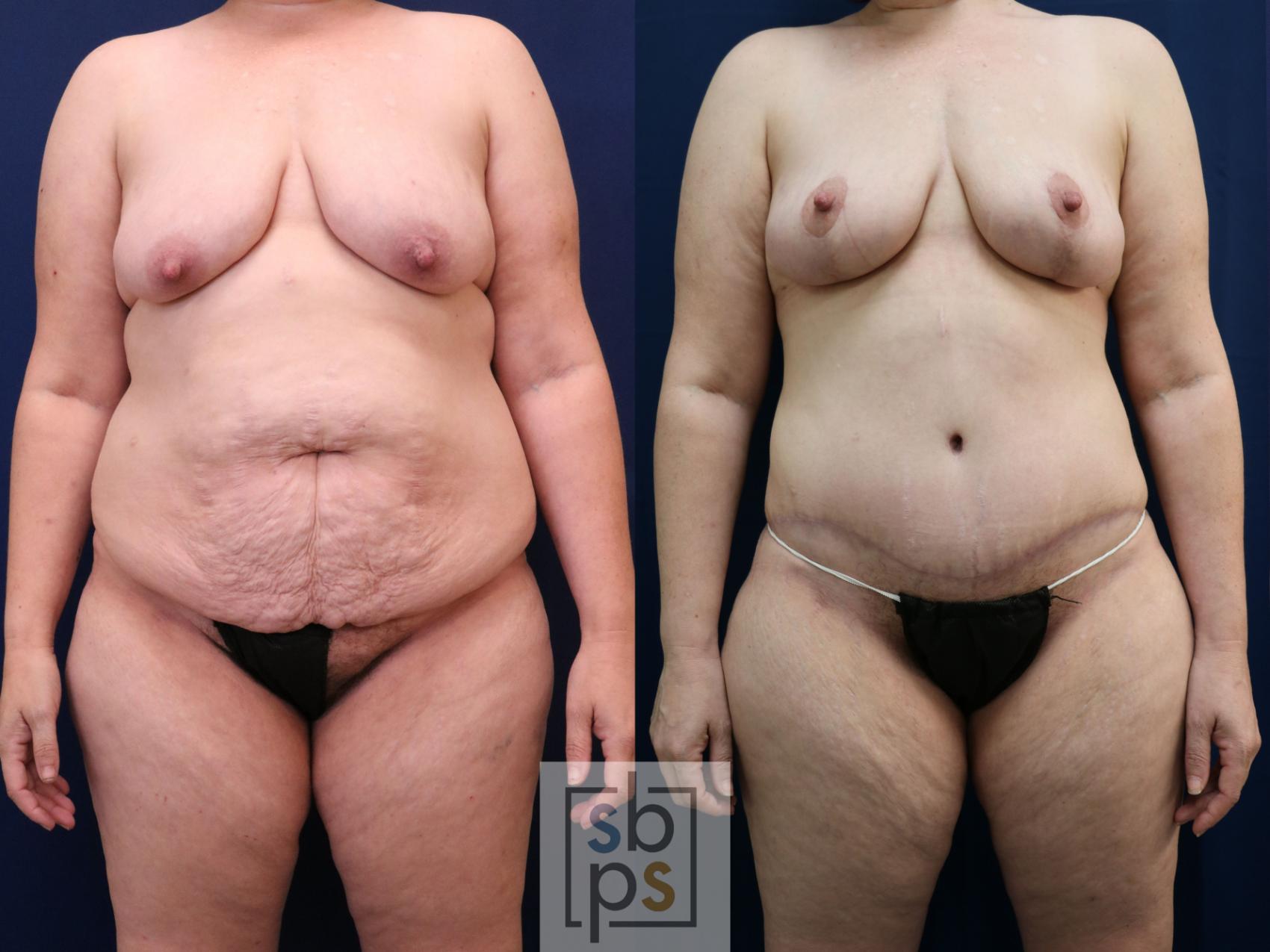 Before & After Tummy Tuck Case 754 Front View in Los Angeles, Torrance & Long Beach, CA