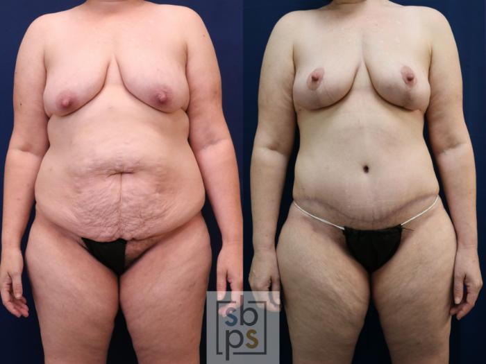 Before & After Tummy Tuck Case 754 Front View in Los Angeles, Torrance & Long Beach, CA