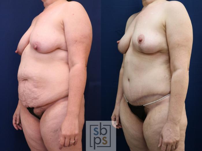 Before & After Tummy Tuck Case 754 Left Oblique View in Los Angeles, Torrance & Long Beach, CA