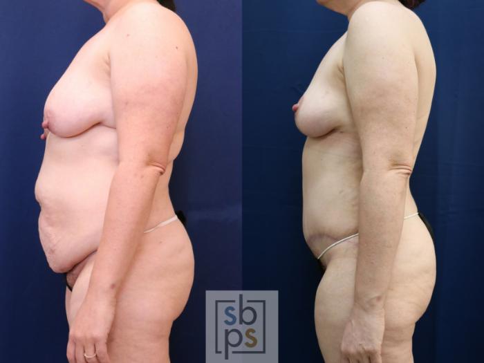 Before & After Tummy Tuck Case 754 Left Side View in Los Angeles, Torrance & Long Beach, CA