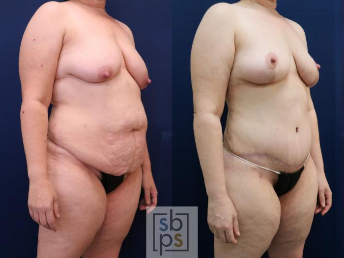 Before & After Tummy Tuck Case 754 Right Oblique View in Los Angeles, Torrance & Long Beach, CA