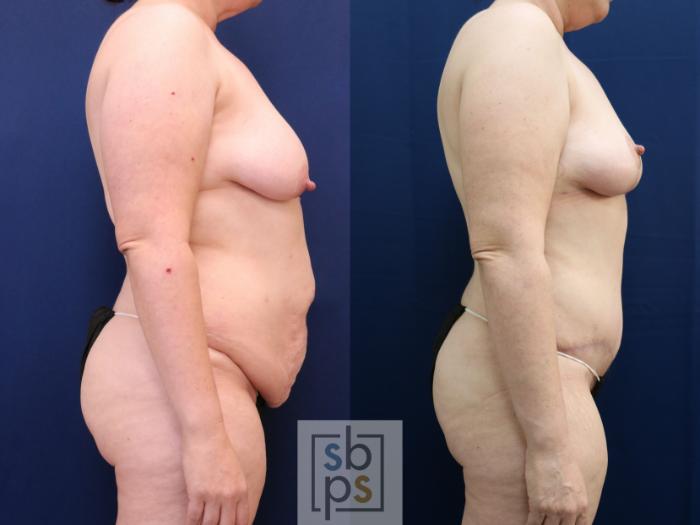 Before & After Tummy Tuck Case 754 Right Side View in Los Angeles, Torrance & Long Beach, CA