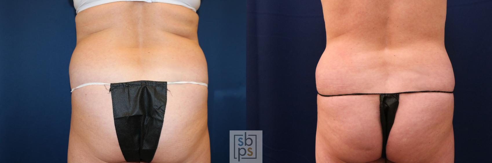 Before & After Tummy Tuck Case 755 Back View in Los Angeles, Torrance & Long Beach, CA