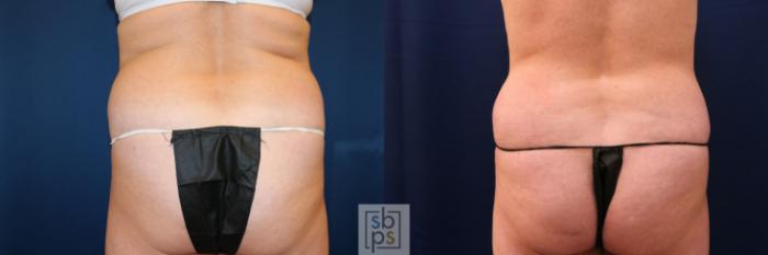 Before & After Tummy Tuck Case 755 Back View in Los Angeles, Torrance & Long Beach, CA