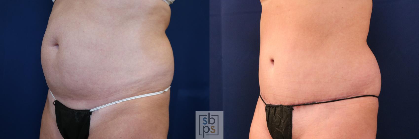 Before & After Tummy Tuck Case 755 Left Oblique View in Los Angeles, Torrance & Long Beach, CA