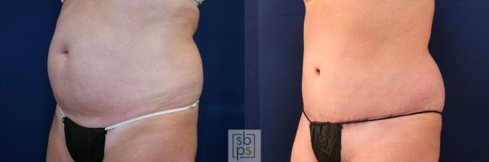 Before & After Tummy Tuck Case 755 Left Oblique View in Los Angeles, Torrance & Long Beach, CA