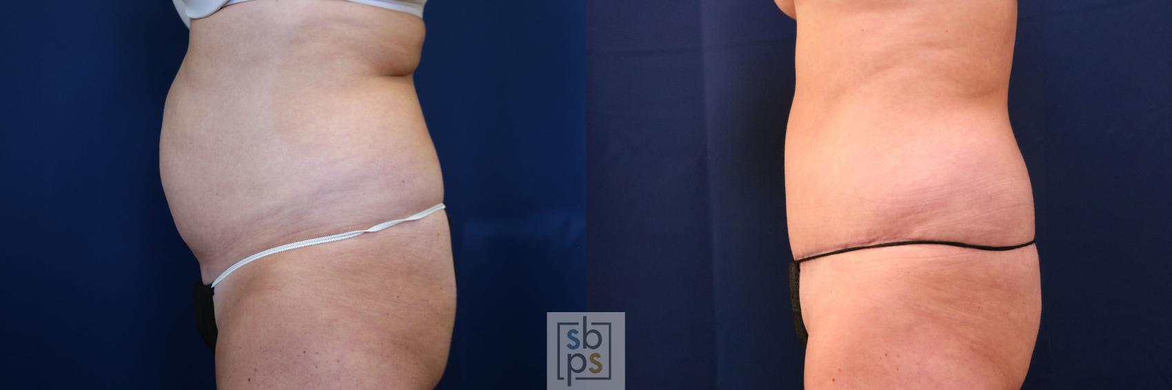 Before & After Tummy Tuck Case 755 Left Side View in Los Angeles, Torrance & Long Beach, CA