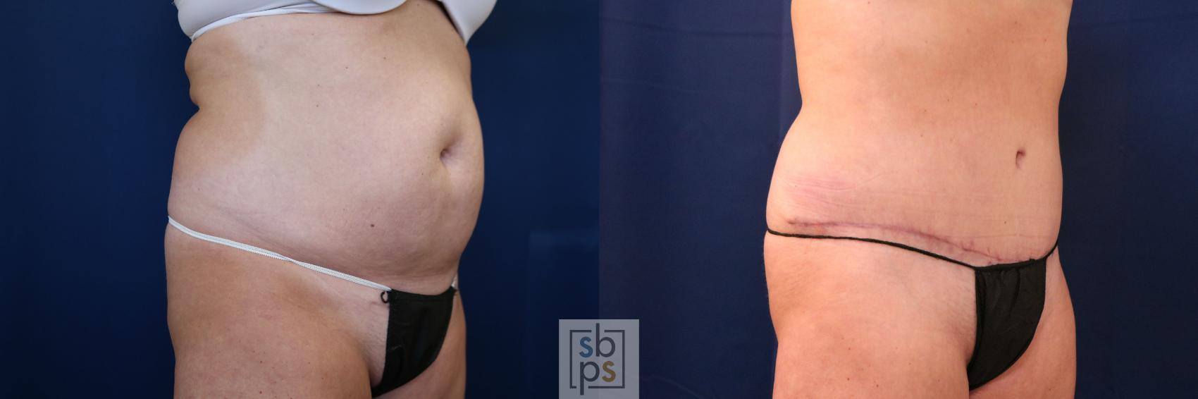 Before & After Tummy Tuck Case 755 Right Oblique View in Los Angeles, Torrance & Long Beach, CA
