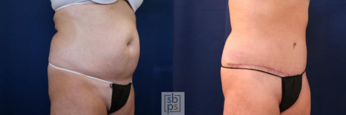 Before & After Tummy Tuck Case 755 Right Oblique View in Los Angeles, Torrance & Long Beach, CA
