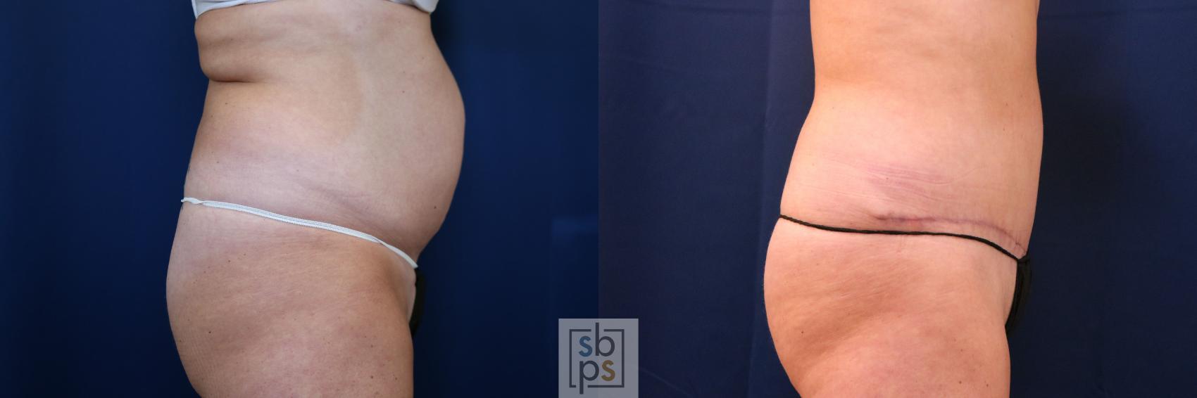 Before & After Tummy Tuck Case 755 Right Side View in Los Angeles, Torrance & Long Beach, CA