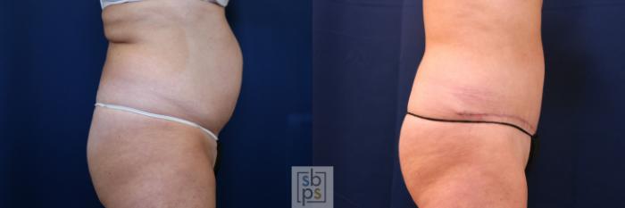 Before & After Tummy Tuck Case 755 Right Side View in Los Angeles, Torrance & Long Beach, CA