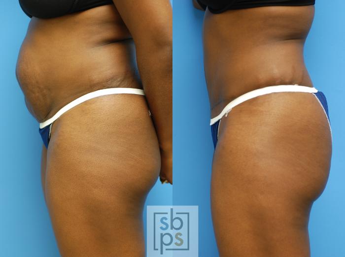 Before & After Tummy Tuck Case 81 View #1 View in Torrance, CA