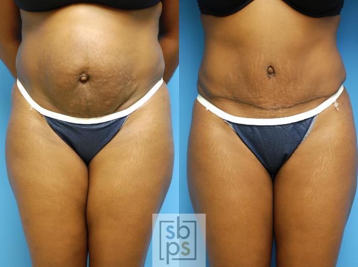 Before & After Tummy Tuck Case 81 View #2 View in Torrance, CA
