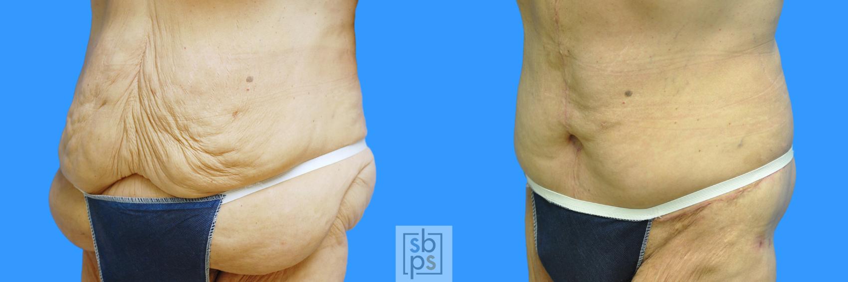 Before & After Tummy Tuck Case 85 View #10 View in Torrance & Los Angeles, CA, CA