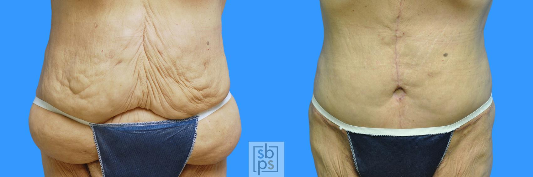Before & After Tummy Tuck Case 85 View #6 View in Torrance, CA