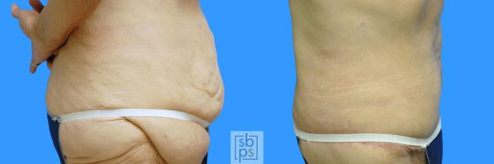 Before & After Tummy Tuck Case 85 View #7 View in Torrance, CA
