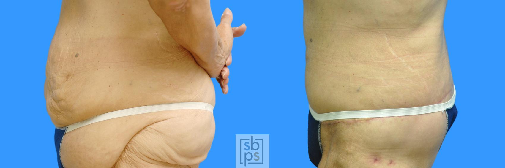 Before & After Tummy Tuck Case 85 View #8 View in Torrance & Los Angeles, CA, CA