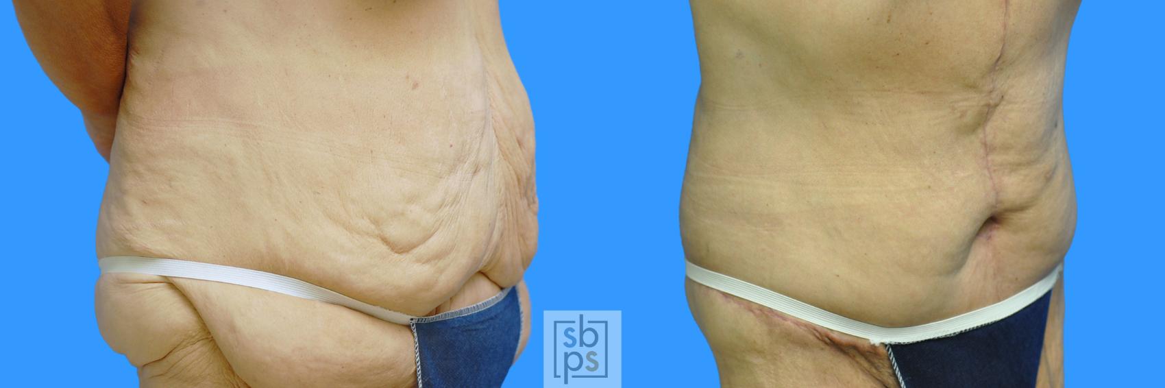 Before & After Tummy Tuck Case 85 View #9 View in Torrance & Los Angeles, CA, CA