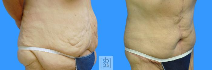Before & After Tummy Tuck Case 85 View #9 View in Torrance, CA