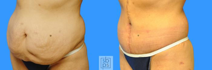 Before & After Tummy Tuck Case 93 View #10 View in Torrance, CA