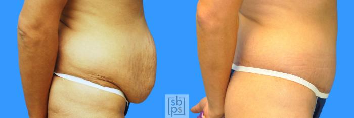 Before & After Tummy Tuck Case 93 View #7 View in Torrance, CA