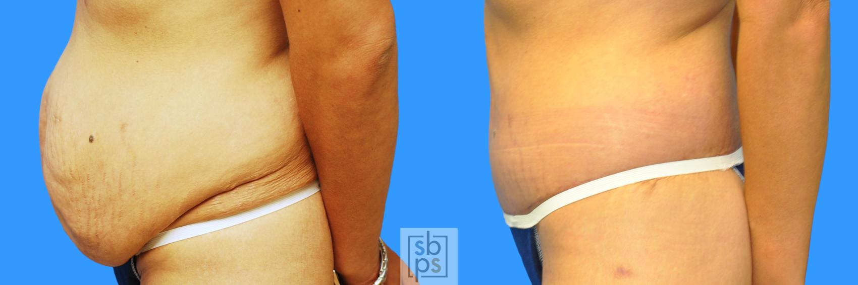 Before & After Tummy Tuck Case 93 View #8 View in Torrance & Los Angeles, CA, CA