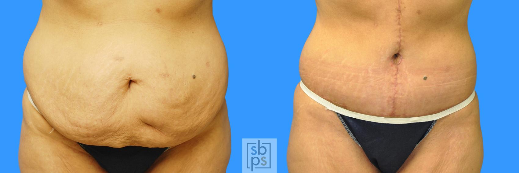 Before & After Tummy Tuck Case 93 View #9 View in Torrance, CA