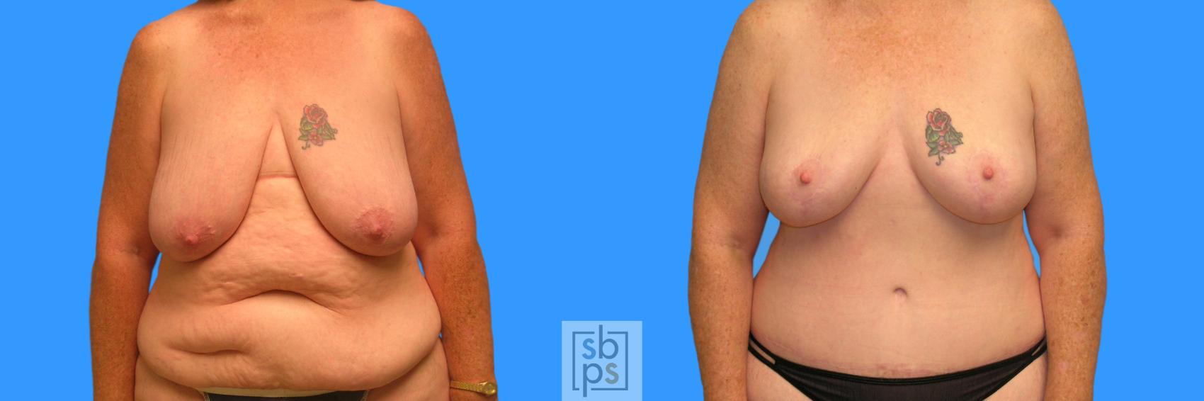 Before & After After Massive Weight Loss Case 96 View #1 View in Torrance, CA